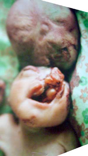 Photos of Babies Deformed at Birth as a Result of Depleted Uranium (DU) 2003 photos: Dr. Jenan Hassan