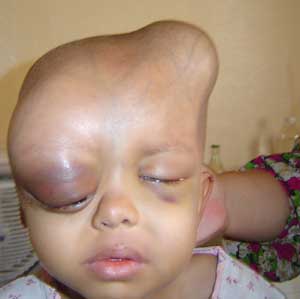 Photos of Babies Deformed at Birth as a Result of Depleted Uranium (DU) 2003 photos: Dr. Jenan Hassan
